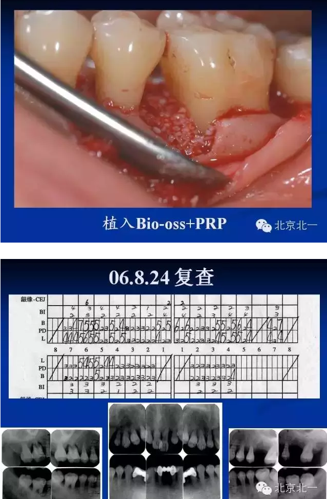 牙周基础治疗的临床病例介绍