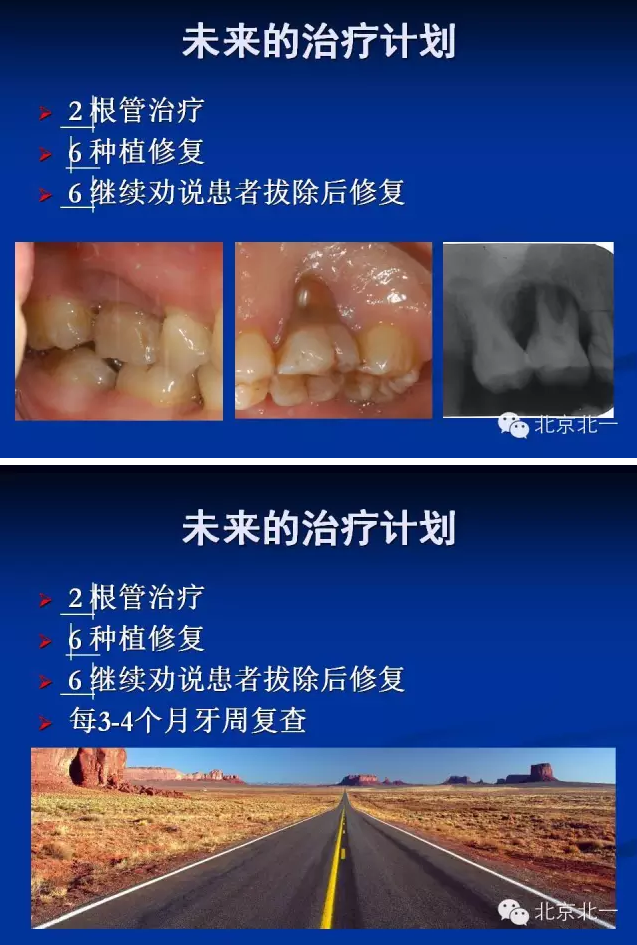 牙周基础治疗的临床病例介绍