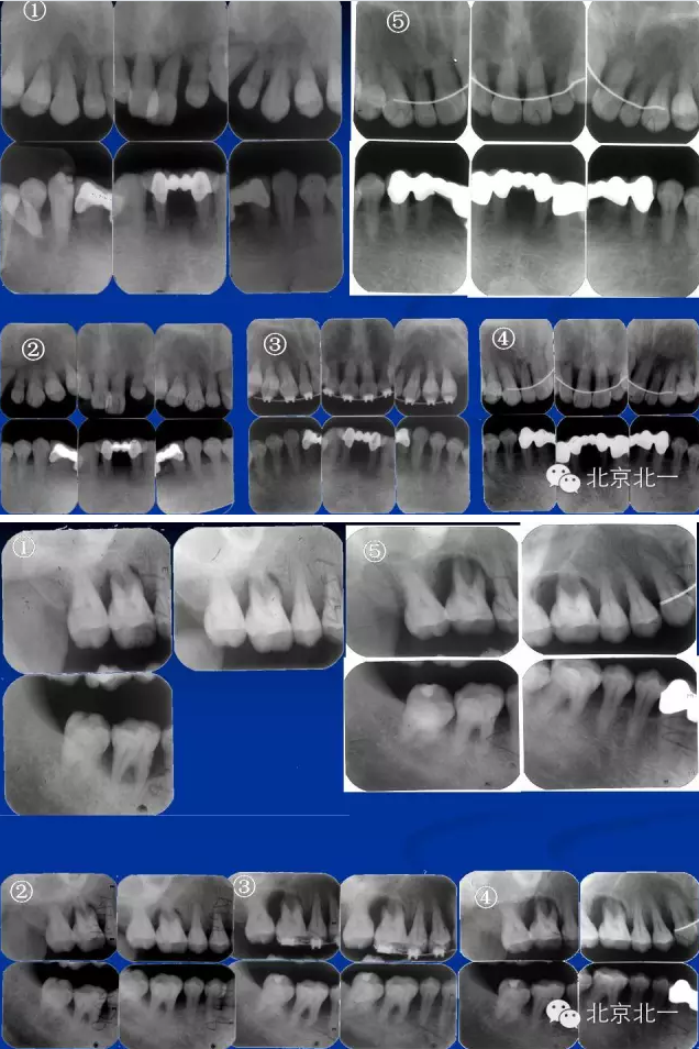 牙周基础治疗的临床病例介绍