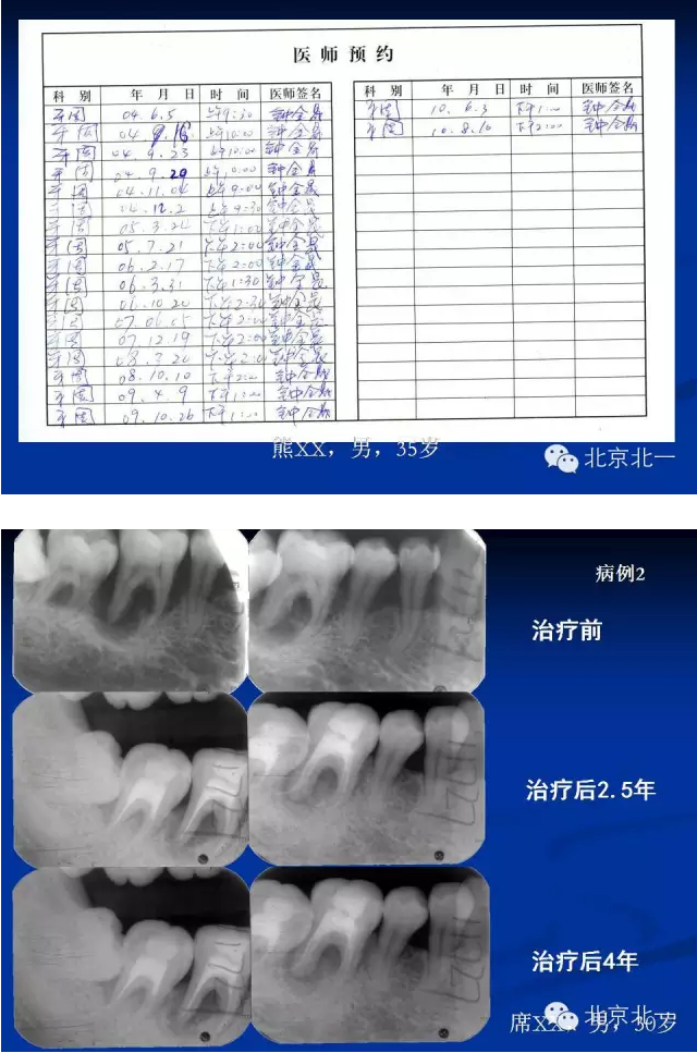 牙周基础治疗的临床病例介绍
