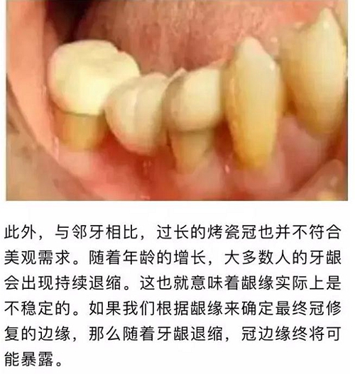 做全冠修复时基牙根面暴露，如何备牙？