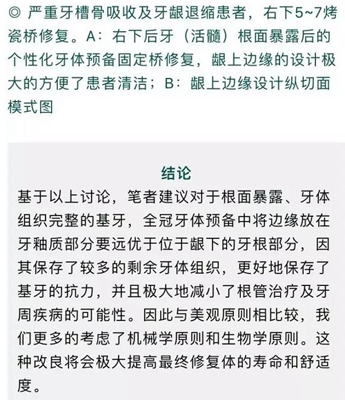 做全冠修复时基牙根面暴露，如何备牙？